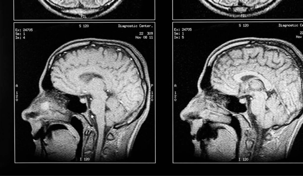 brain injury tomography scan grey scale