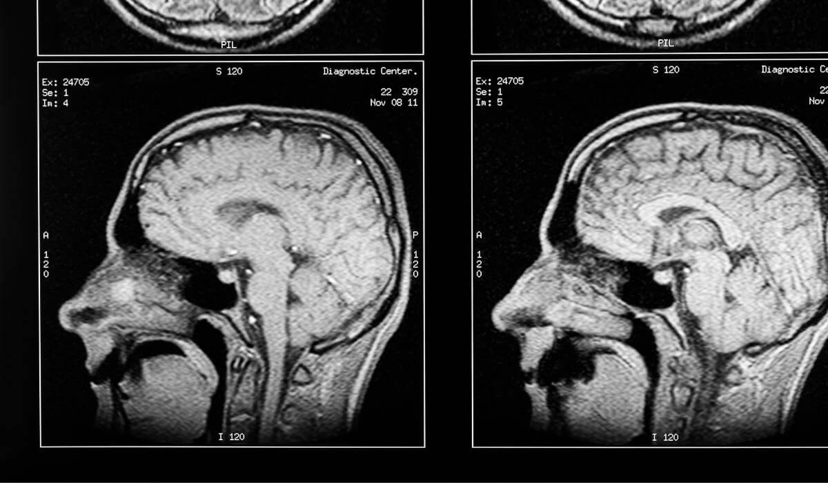 traumatic brain injury