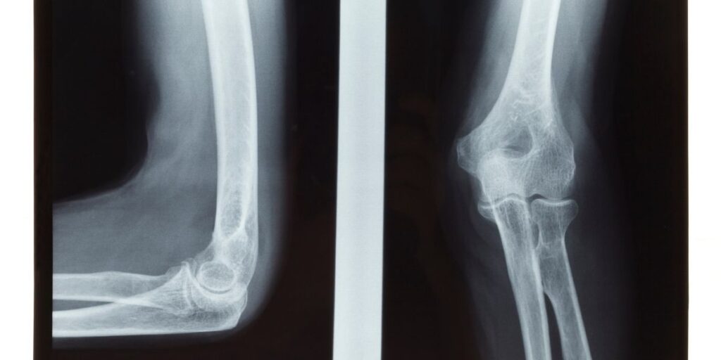 elbow injury claim evidence medical scanning