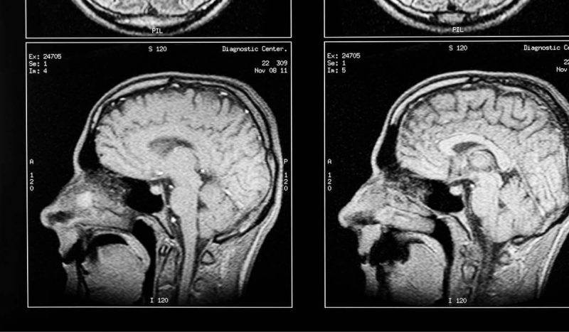traumatic brain injury
