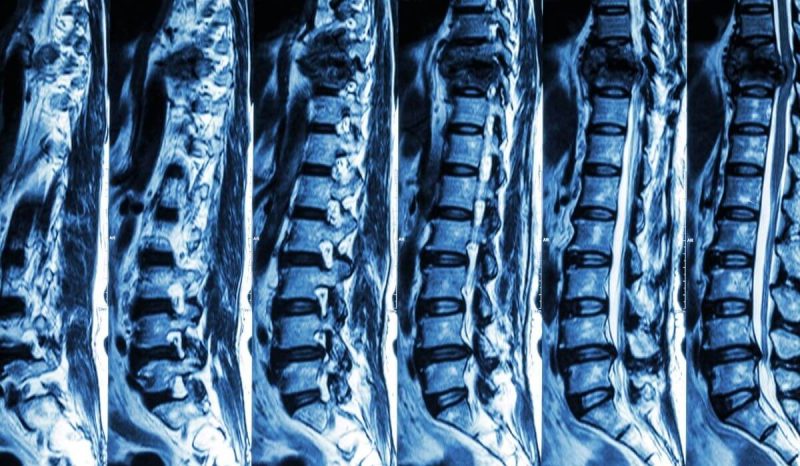 spine injury screen spine injury screen